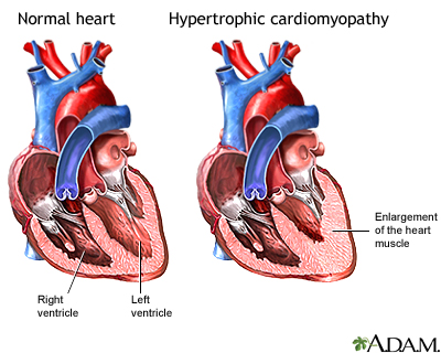 Hypertrophic cardiomyopathy