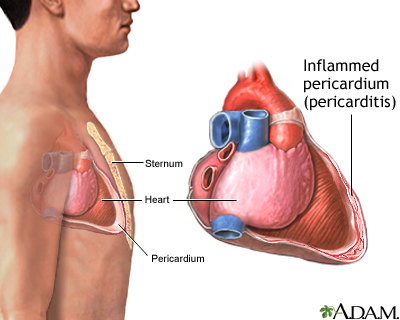 Pericarditis