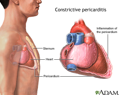 Constrictive pericarditis