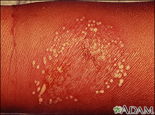 Pustules, superficial on the arm