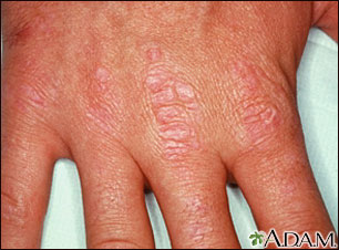 Dermatomyositis, Gottron's papules on the hand