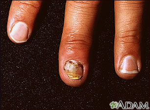 Nail infection, candidal