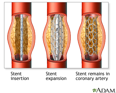 Coronary artery stent