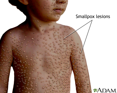 Smallpox lesions