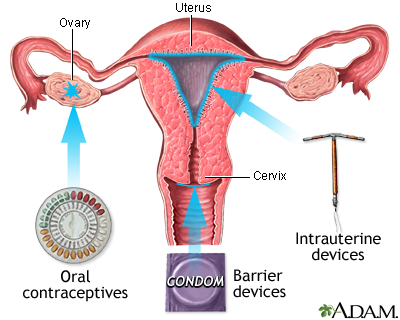 Birth control methods