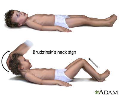 Brudzinski's sign of meningitis