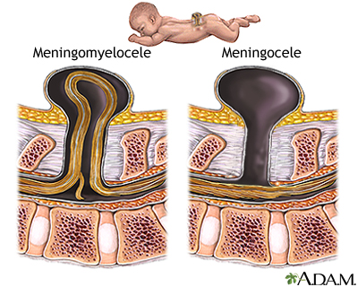 Spina bifida