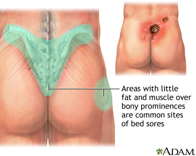 Areas where bedsores occur