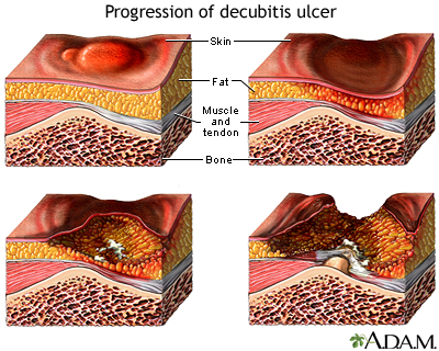 Progression of a decubitis ulcer