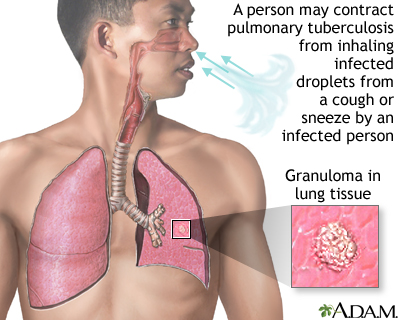 Tuberculosis of the lungs