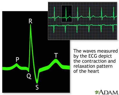 Normal sinus rhythm