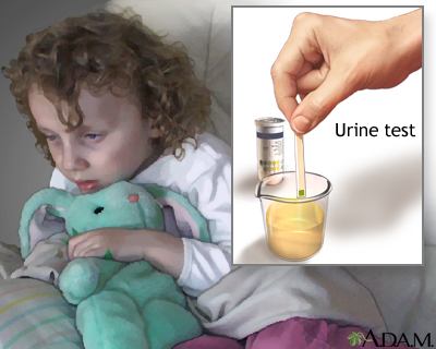 Urine test for ketoacidosis