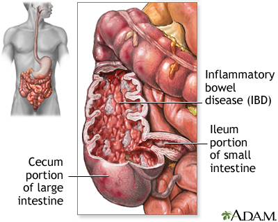 Inflammatory bowel disease