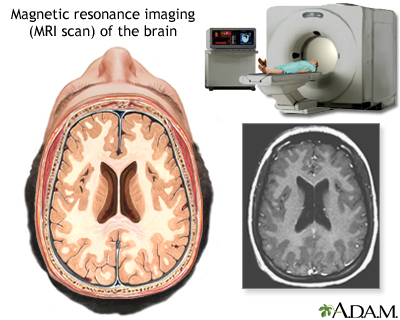 MRI of the brain