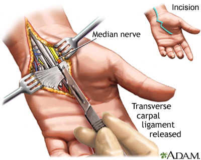 Carpal tunnel surgical procedure