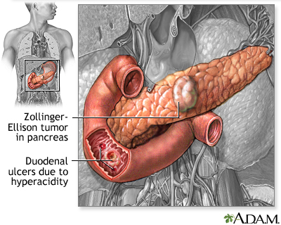 Cause of peptic ulcers