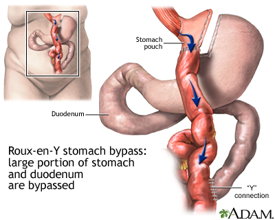 Roux-en-Y stomach surgery for weight loss