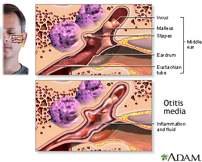 Middle ear infection (otitis media)