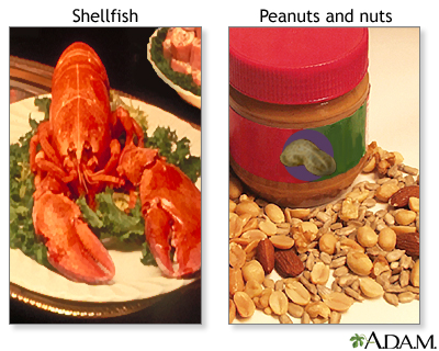 Food allergies