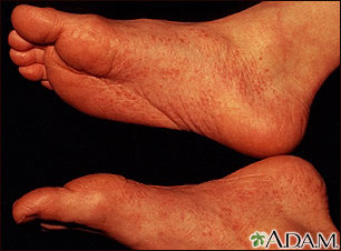 Reiter's syndrome - view of the feet