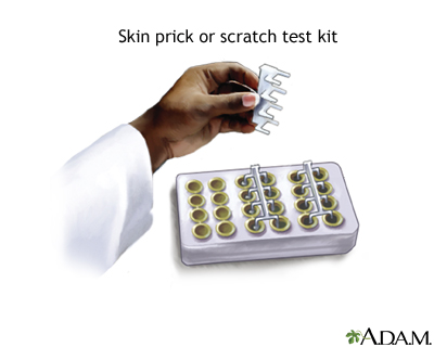 Allergy skin prick or scratch test