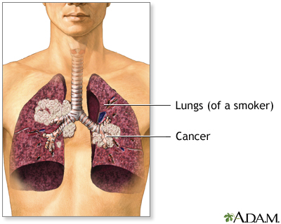 Secondhand smoke and lung cancer