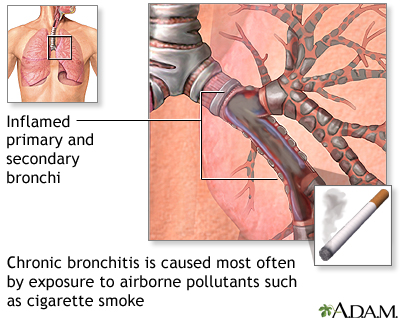 Cause of chronic bronchitis