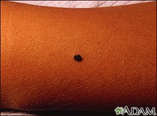 Benign juvenile melanoma