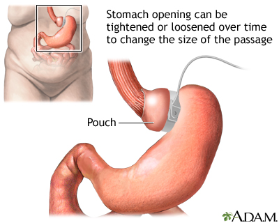 Adjustable gastric banding