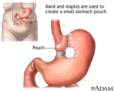 Vertical banded gastroplasty