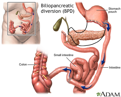 Biliopancreatic diversion (BPD)