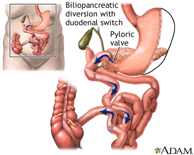 Biliopancreatic diversion with duodenal switch