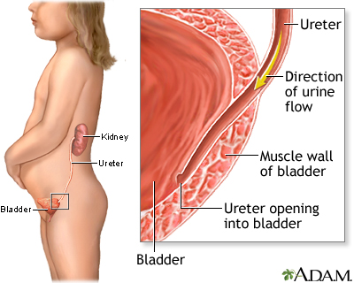 Vesicoureteral reflux