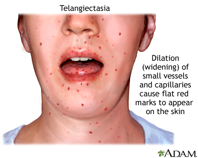 Telangiectasia