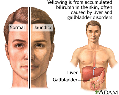 Jaundice