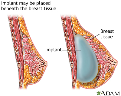 Procedure