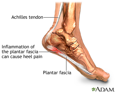 Plantar fasciitis