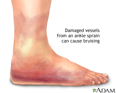 Ankle sprain swelling