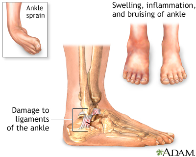 Ankle sprain