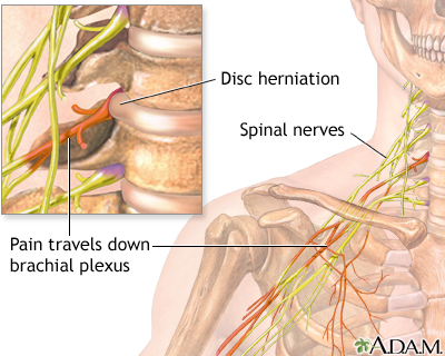 Neck pain