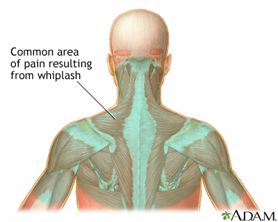 Location of whiplash pain