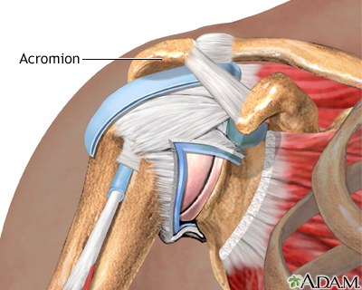 Impingement syndrome