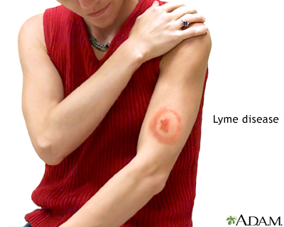 Lyme disease