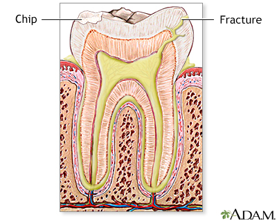 Fractured tooth