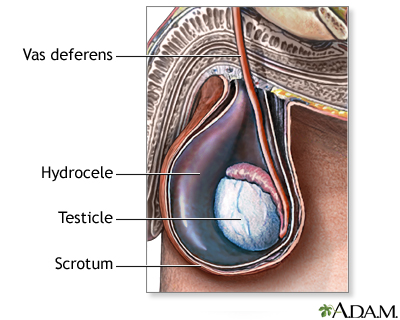 Hydrocele