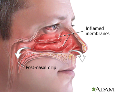 Runny and stuffy nose