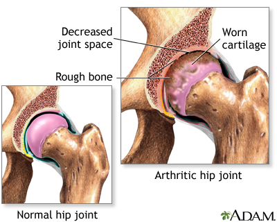 Arthritis in hip