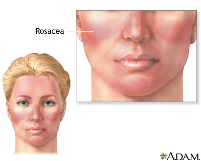 Rosacea