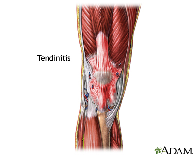 Tendinitis