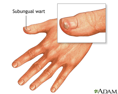 Subungual wart